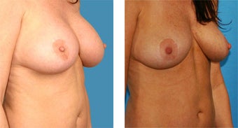 Breast Implant Removal with Internal Lift