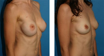Breast Implant Removal with Internal Lift