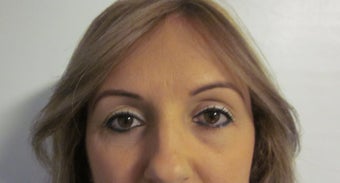 Forehead Lift/ Quad Blepharoplatsy