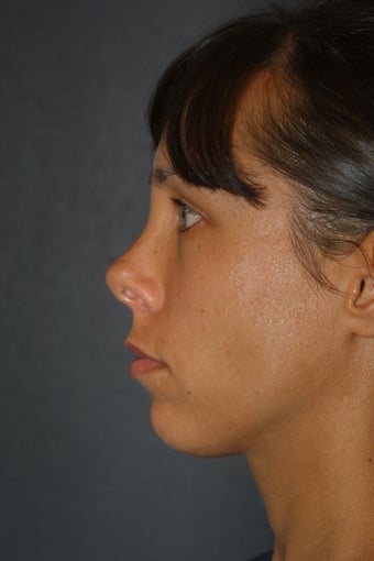 Revision Rhnioplasty
