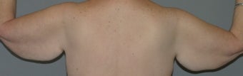 Arm-lift, Brachioplasty