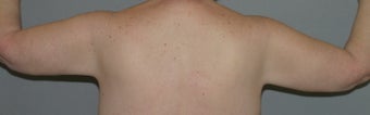 Arm-lift, Brachioplasty