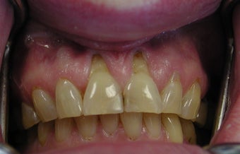 Gum lift (Crown Lengtheing), Root coverage with soft tissue Graft, 