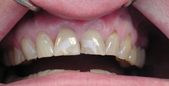 Gum lift (Crown Lengtheing), Root coverage with soft tissue Graft, 