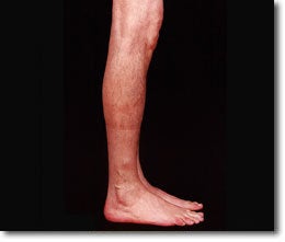 Calf Implant