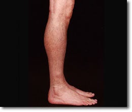 Calf Implant
