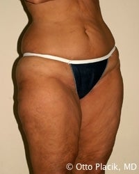 Thigh and Buttock Lift