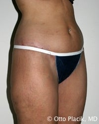 Thigh and Buttock Lift