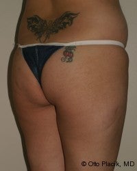 Buttock Augmentation