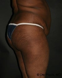Buttock Augmentation