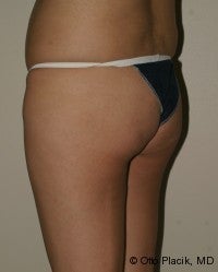 Buttock Augmentation