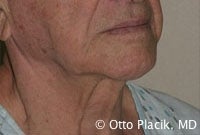 Cervicoplasty