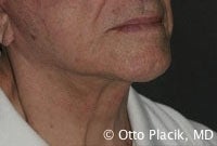Cervicoplasty