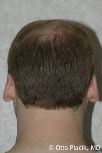 Otoplasty
