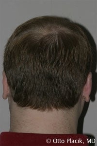 Otoplasty