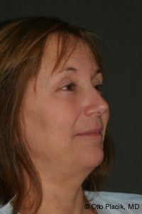 Neck Lift