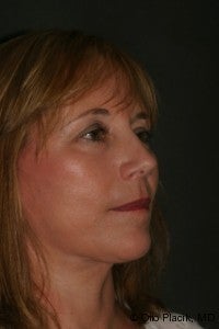 Neck Lift