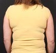Bra Line Back Lift