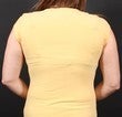 Bra Line Back Lift