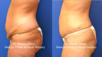 Mini Tummy Tuck