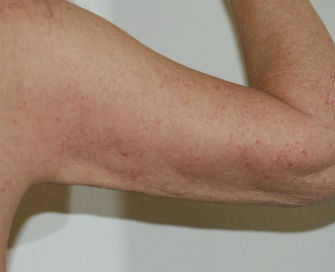 Arm lift