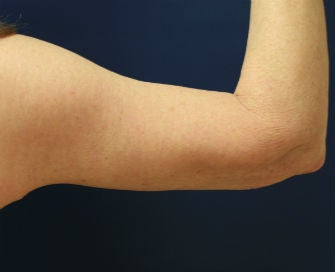 Arm lift