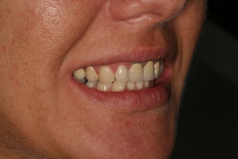 Dental crowns, dental implants, dental veneers