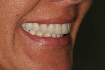 Dental crowns, dental implants, dental veneers