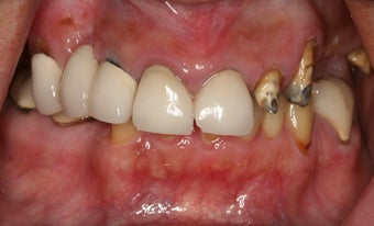 Dental implants, implant overdenture