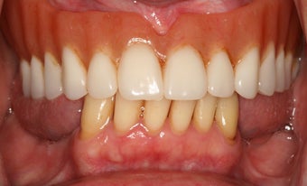 Dental implants, implant overdenture