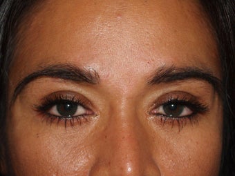 Before, Immediately After, and 1 Year After Eyebrow Transplant Procedure