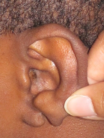 Torn Earlobe Repair