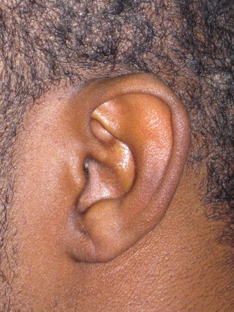 Torn Earlobe Repair