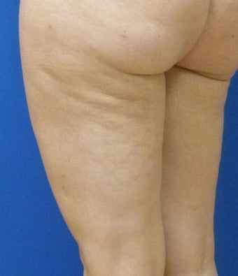 Cellulaze