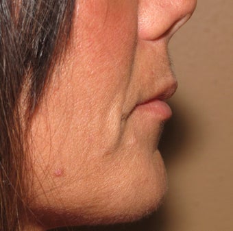 Lip lift - permanent lip enhancement