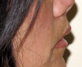 Lip lift - permanent lip enhancement
