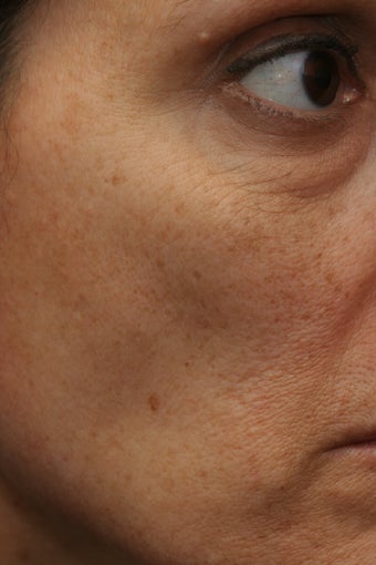Portrat PSR3 Plasma Skin Resurfacing