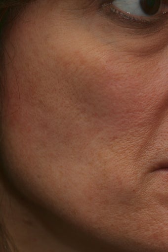 Portrat PSR3 Plasma Skin Resurfacing