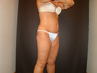 CoolSculpting