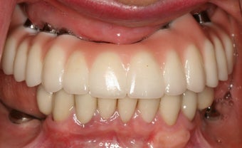 Upper Zirkonia hybrid prosthesis