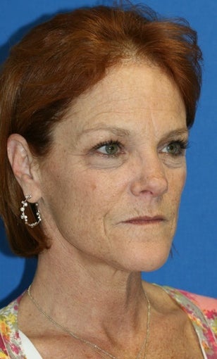 Facelift with Extended Necklift, Fat Transfer, and Skin Pinch