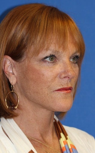 Facelift with Extended Necklift, Fat Transfer, and Skin Pinch
