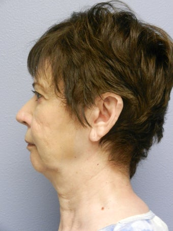 Lower Face Neck Lift 