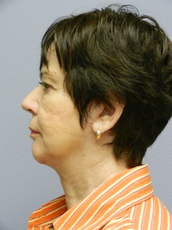 Lower Face Neck Lift 