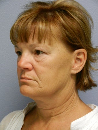 Lower Face with Neck Lift