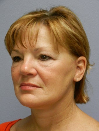 Lower Face with Neck Lift
