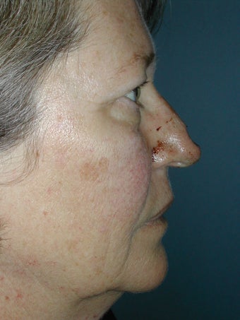 Chemical Peel and Injectables