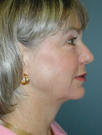 Chemical Peel and Injectables