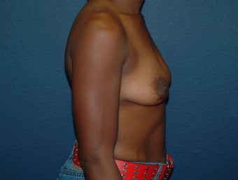Breast Augmentation