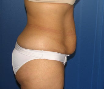 Tummy Tuck